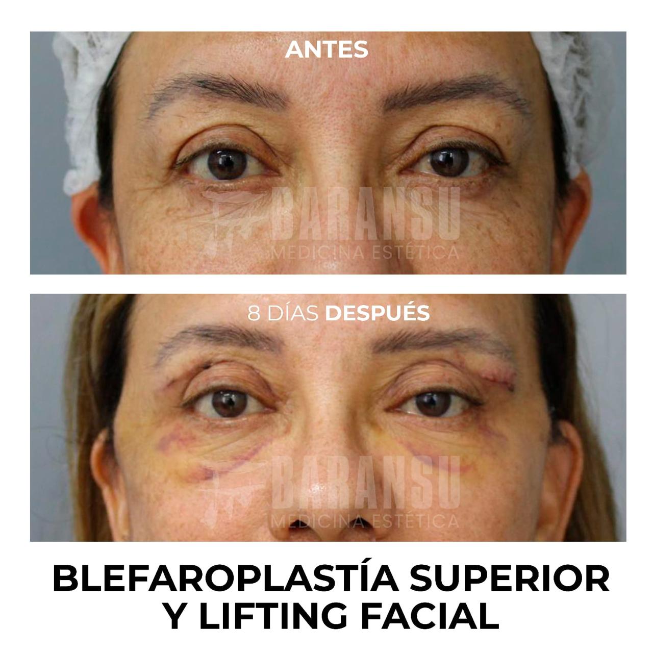 Blefaroplastía Superior y Lifting Facial 36