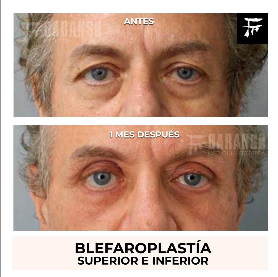 Blefaroplastia Superior e Inferior 37