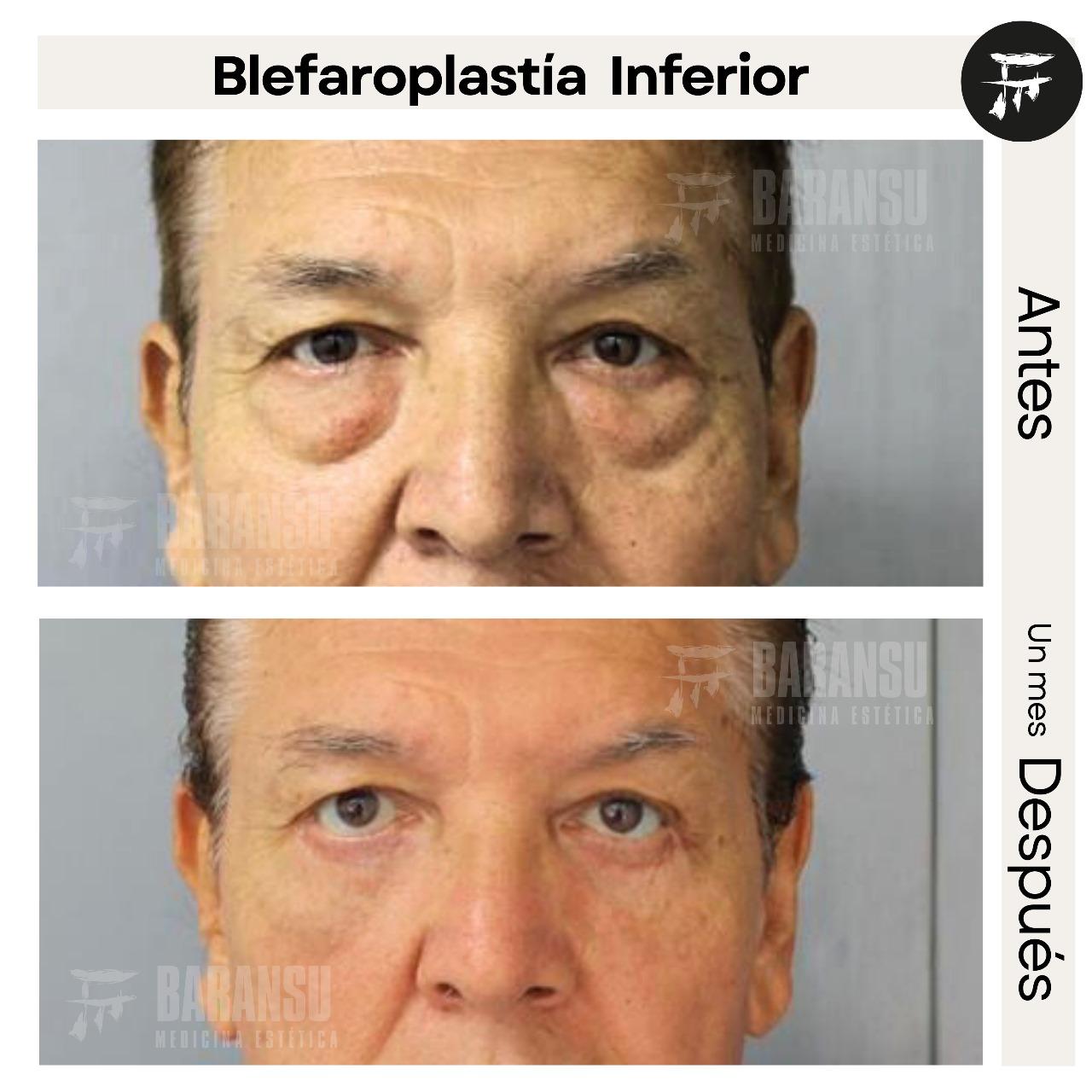 Blefaroplastia Inferior 38