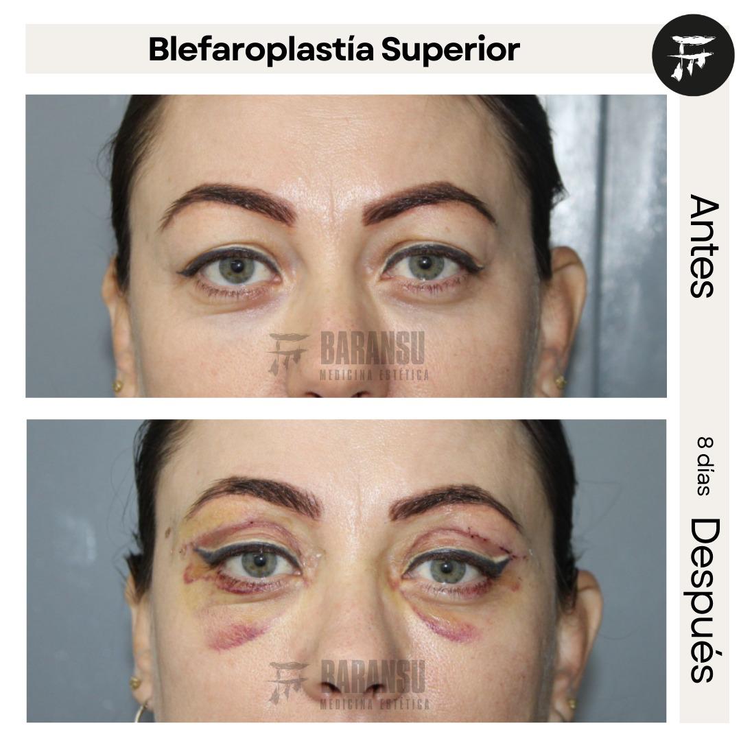 Blefaroplastia Superior 39