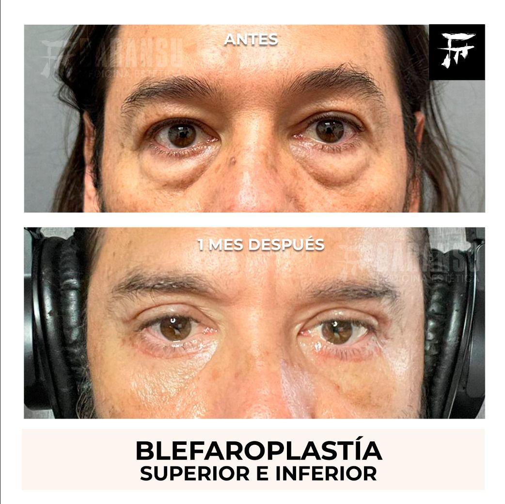 Blefaroplastía Superior e Inferior 40