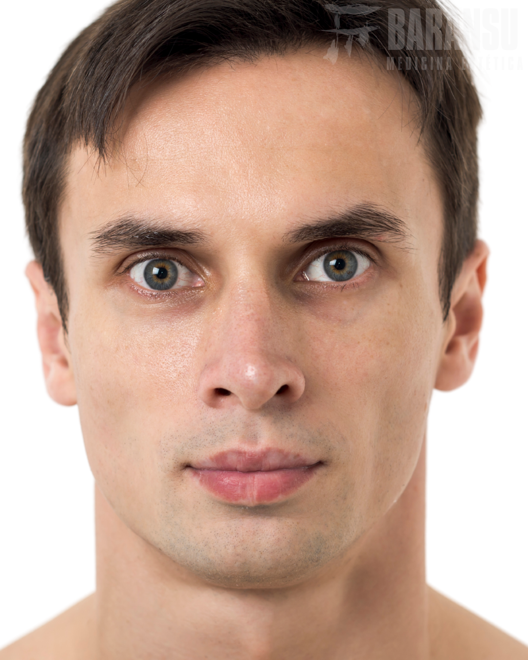 Relleno de ojeras